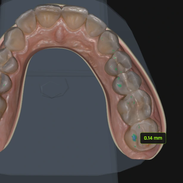 Mapa de contactos oclusales en color sobre modelos dentales 3D en el articulador virtual